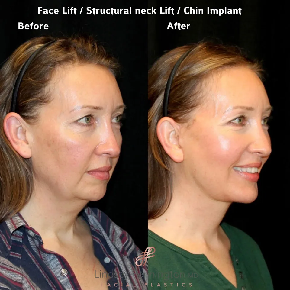 Facelift before and after photo