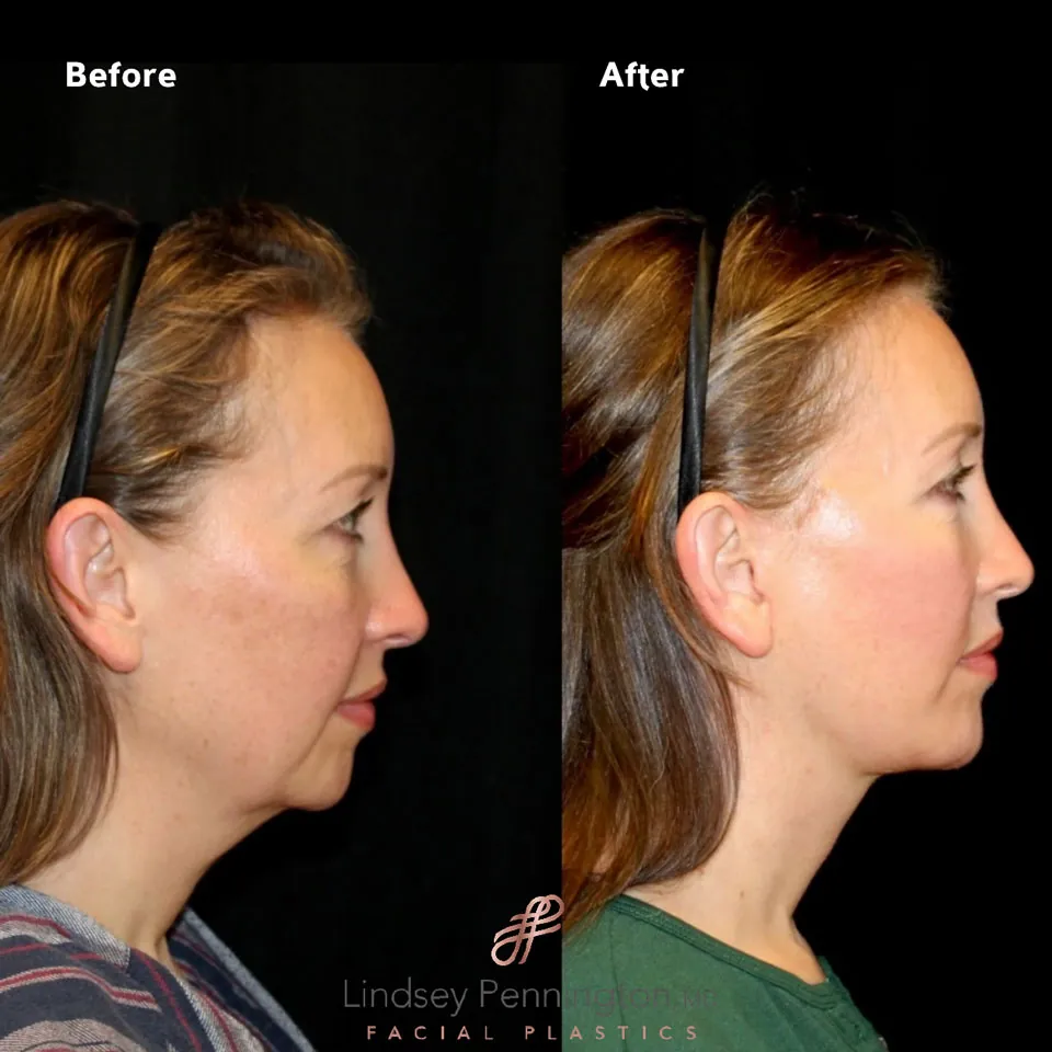Facelift before and after photo