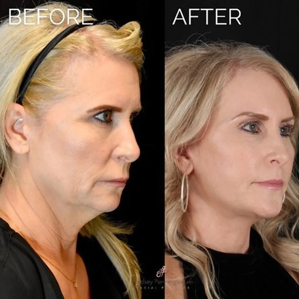 Facelift before and after photo