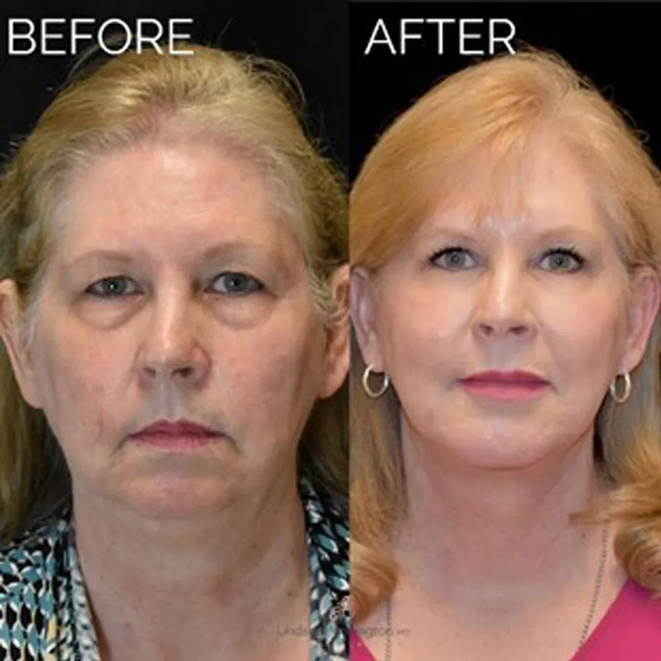 Facelift before and after photo