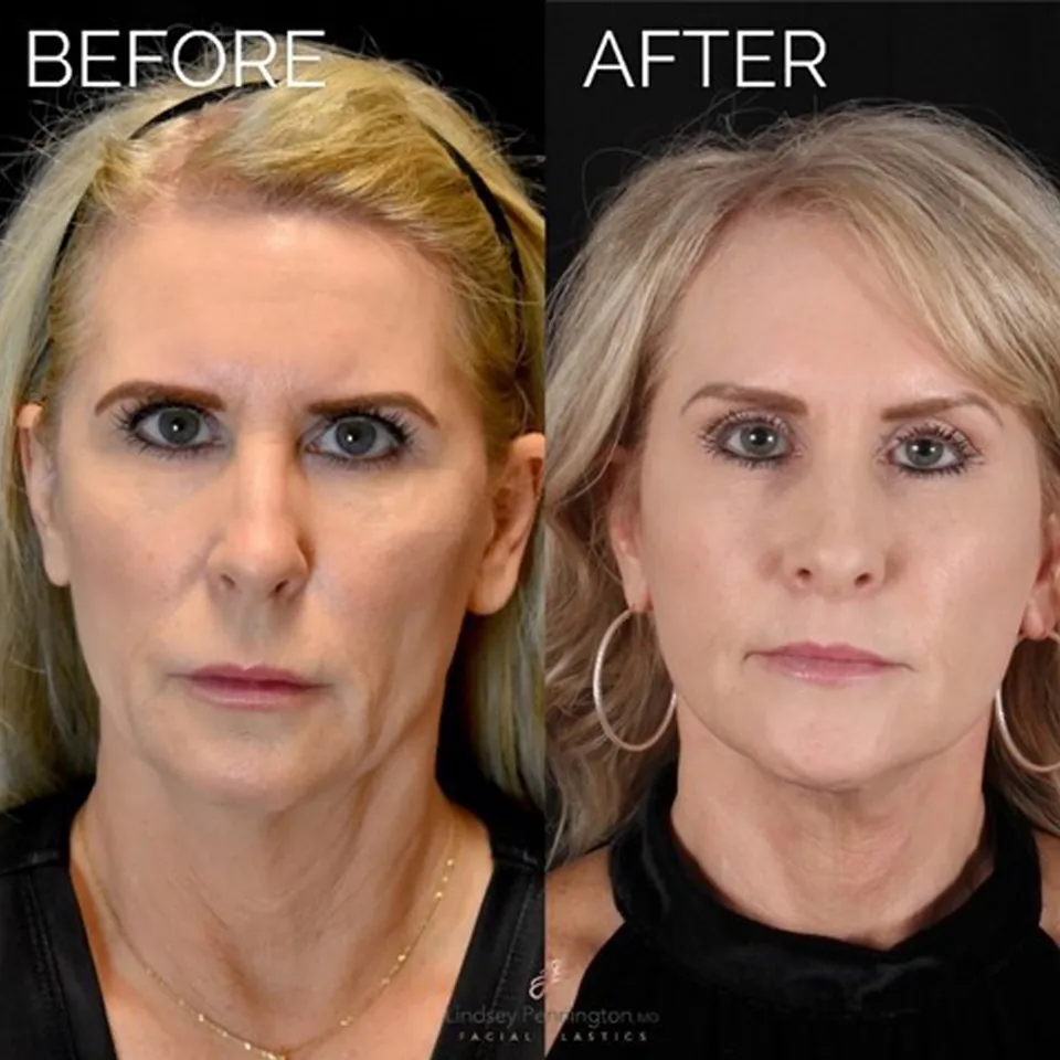 Facelift before and after photo