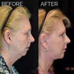 Facelift before and after photo