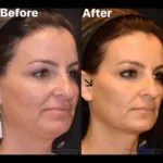 Dermal Filler before and after photo