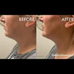 Dermal Filler before and after photo