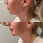 Dermal Filler before and after photo