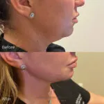 Dermal Filler before and after photo