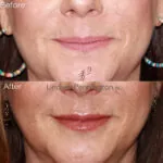 Dermal Filler before and after photo