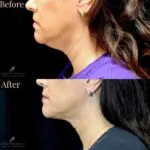 Kybella before and after photo