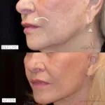 Lip Lift before and after photo