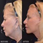 Lip Lift before and after photo