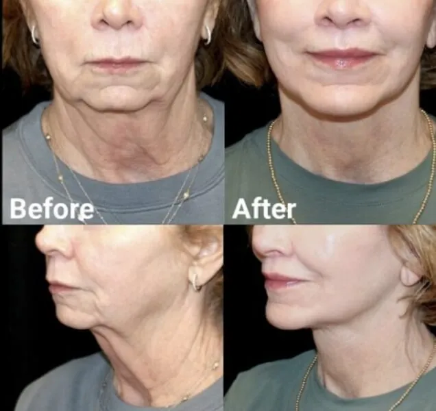 plastic surgery before and after photo