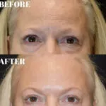plastic surgery before and after photo