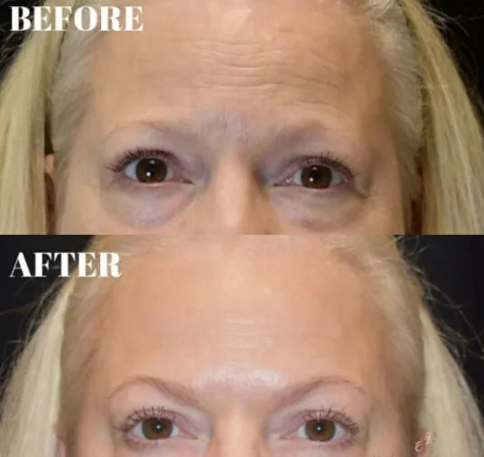 plastic surgery before and after photo