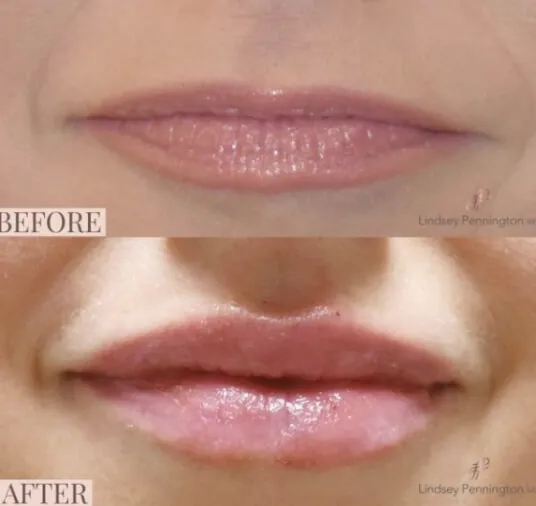 lip filler before and after photo