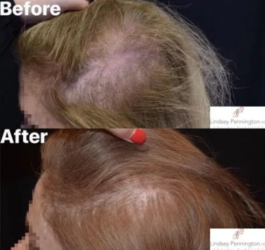 hair restoration before and after photo