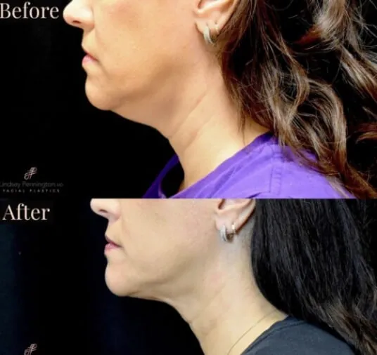 plastic surgery before and after photo