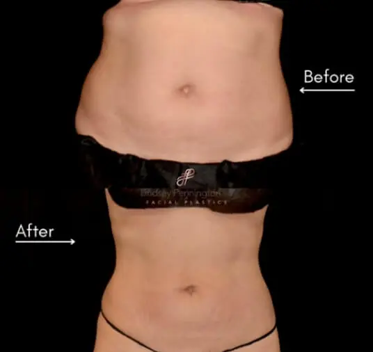 plastic surgery before and after photo
