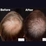 PRP Hair Restoration before and after photo