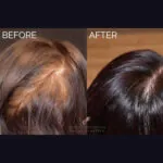 PRP Hair Restoration before and after photo