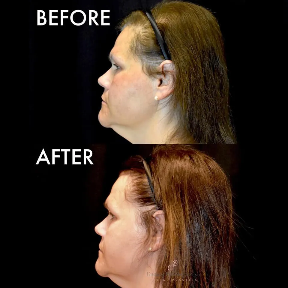 PRP Hair Restoration before and after photo