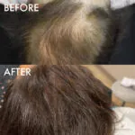 PRP Hair Restoration before and after photo