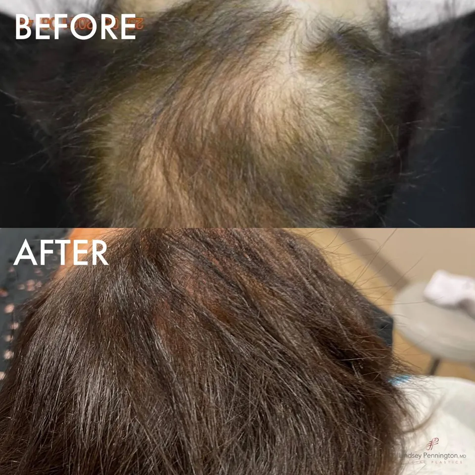 PRP Hair Restoration before and after photo