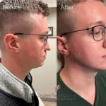 Rhinoplasty before and after photo