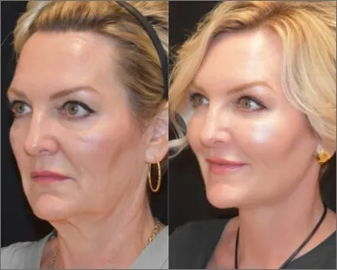 plastic surgery before and after photo