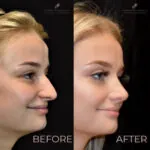 Rhinoplasty before and after photo