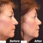 Rhinoplasty before and after photo