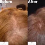 Prp hair restoration before and after photos