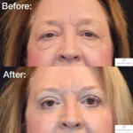 Blepharoplasty before and after photo