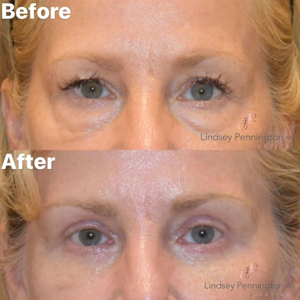 Blepharoplasty before and after photo