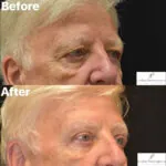 Blepharoplasty before and after photo