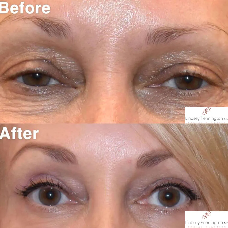 Blepharoplasty before and after photo