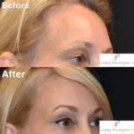 Blepharoplasty before and after photo