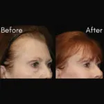Blepharoplasty before and after photo