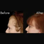 Blepharoplasty before and after photo