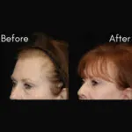 Blepharoplasty before and after photo