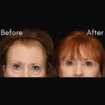 Blepharoplasty before and after photo