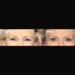 Blepharoplasty before and after photo