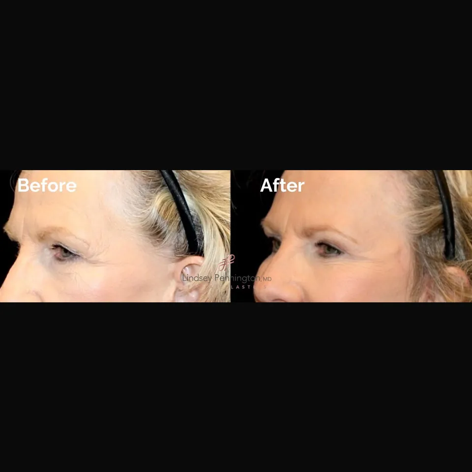 Blepharoplasty before and after photo