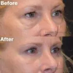 Blepharoplasty before and after photo