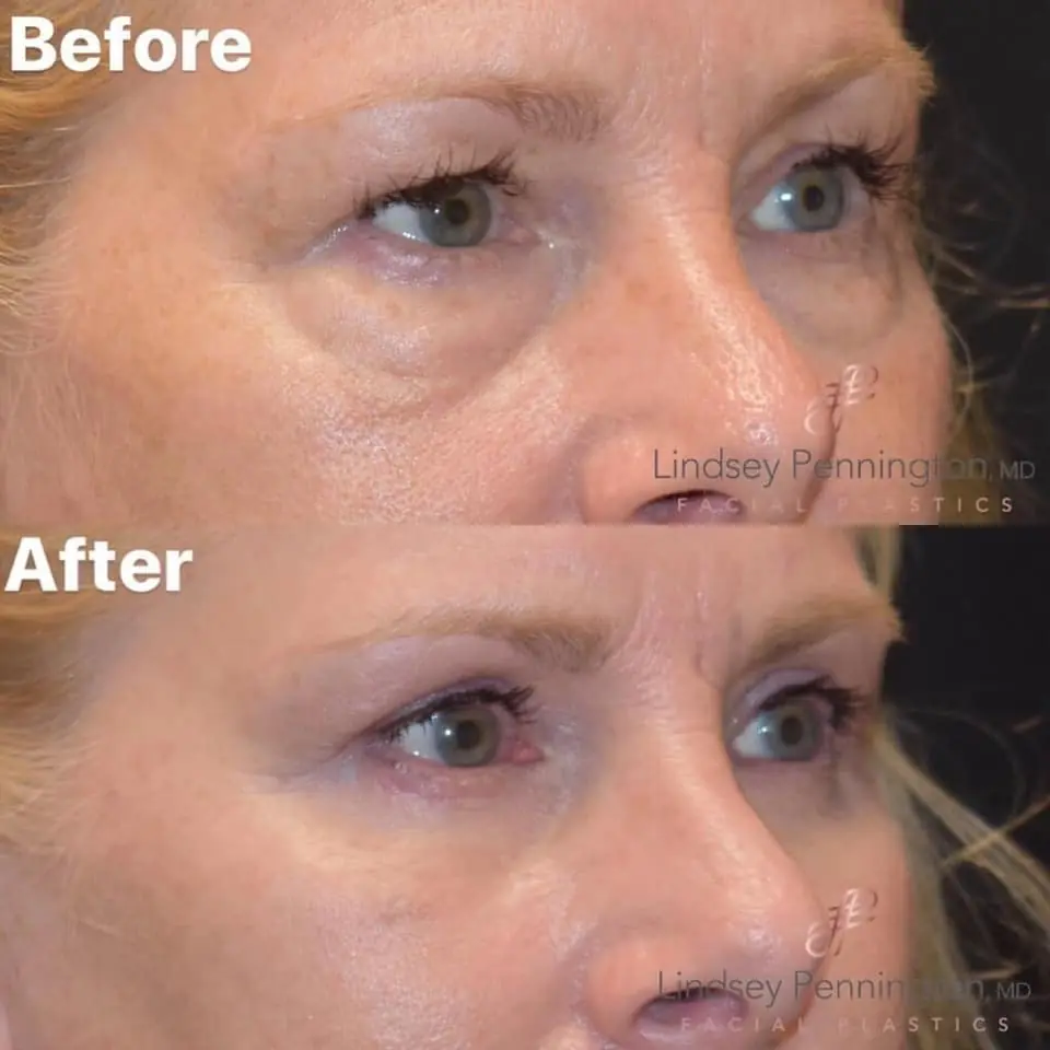 Blepharoplasty before and after photo