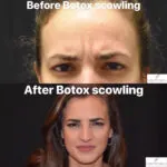 botox before and after photo