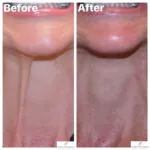 botox before and after photo