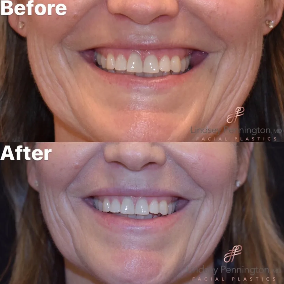 botox before and after photo