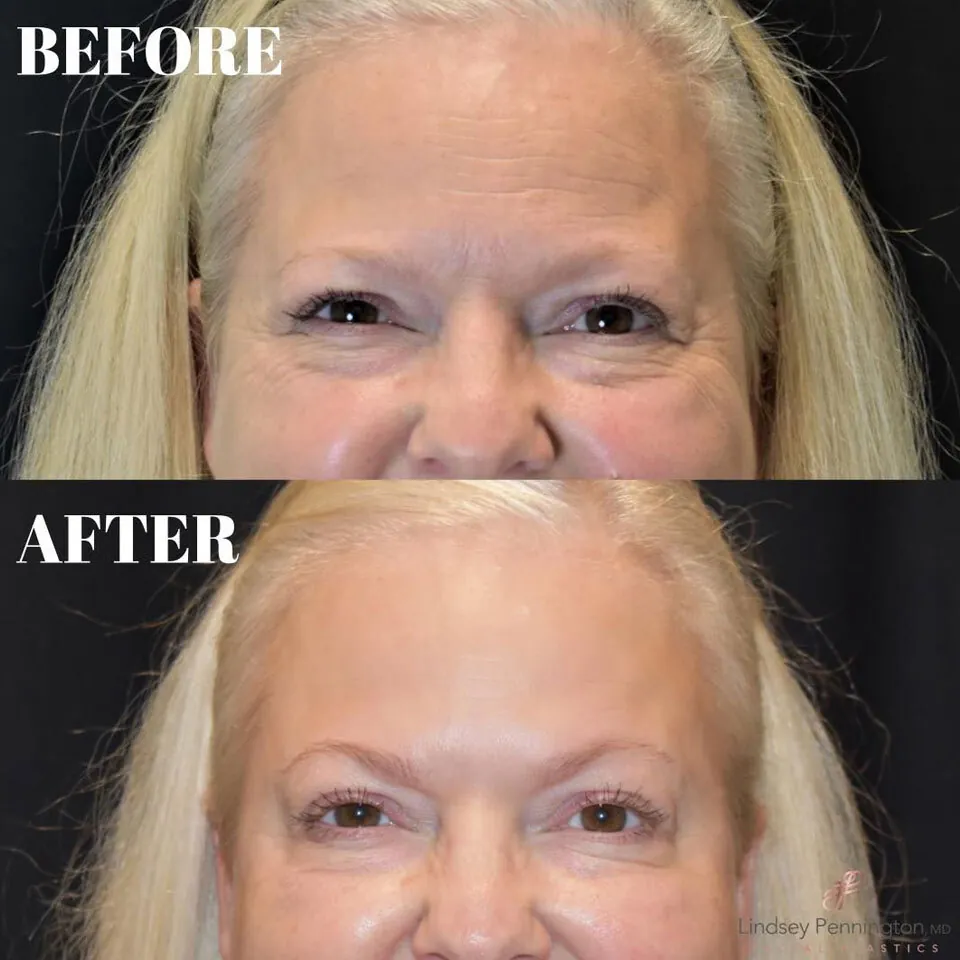 Botox before and after photo