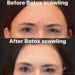 botox before and after photo