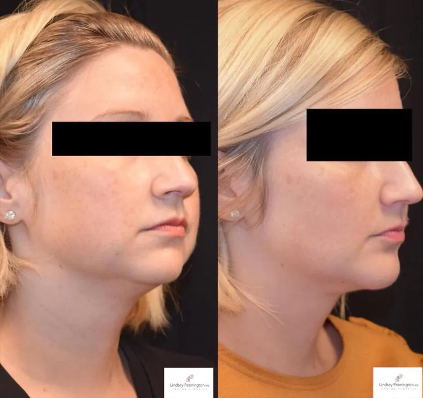 Buccal Fat Removal before and after photo